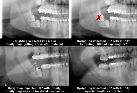 Upright molars with mini implants TADs case 2